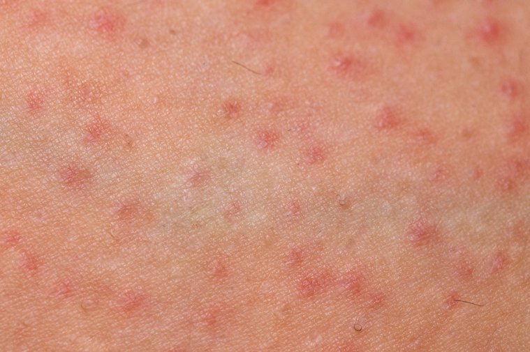 健保皮膚病就醫指南3／濕疹病灶在皮膚 改善卻靠睡眠 – 聯合新聞網